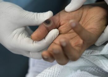 Медиків у всьому світі налякав смертоносний штам віспи: постраждали вже чотири країни